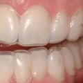 Does teeth whitening damage enamel?