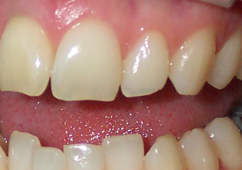 What teeth whitening do dentists recommend?