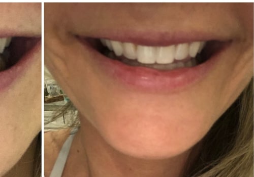 Does teeth whitening gel expire?