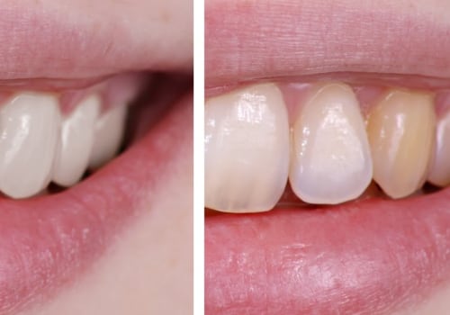 Can tooth whitening damage enamel?