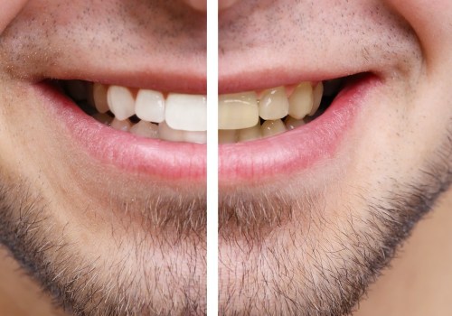 Is teeth whitening good for your teeth?