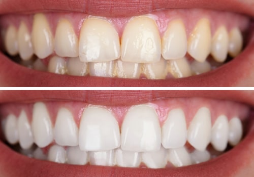 Difference between teeth whitening toothpaste and professional whitening treatments