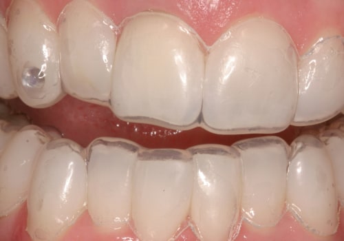 Does tooth whitening weaken enamel?
