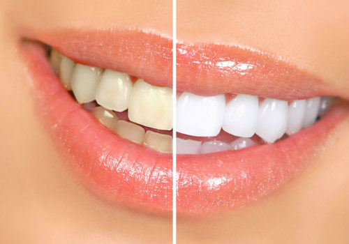DIY Teeth Whitening Vs. Professional Treatment