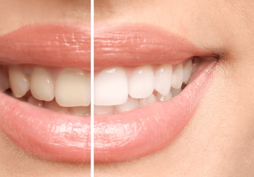 What is the Best Treatment to Whiten Teeth