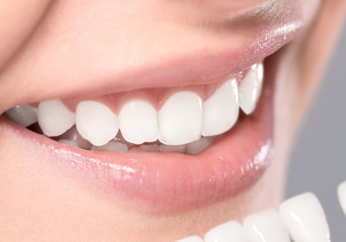 What is the #1 teeth whitening?