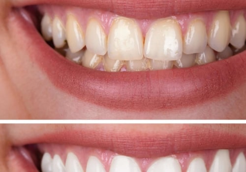 How long do whitened teeth last?